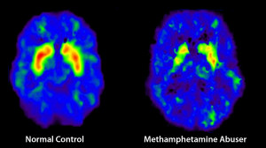 brain scan meth user