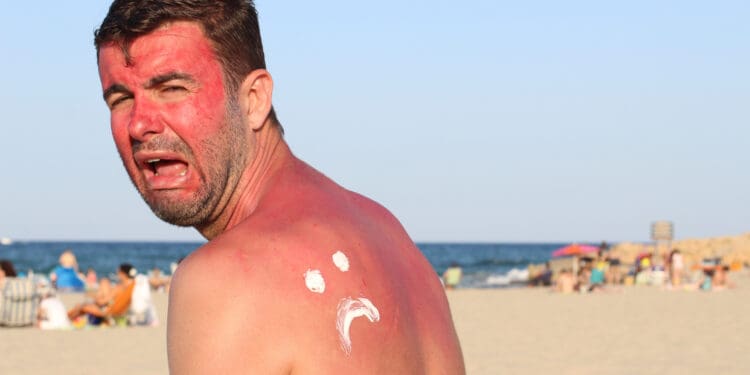 Man crying because he has a bad sunburn.
