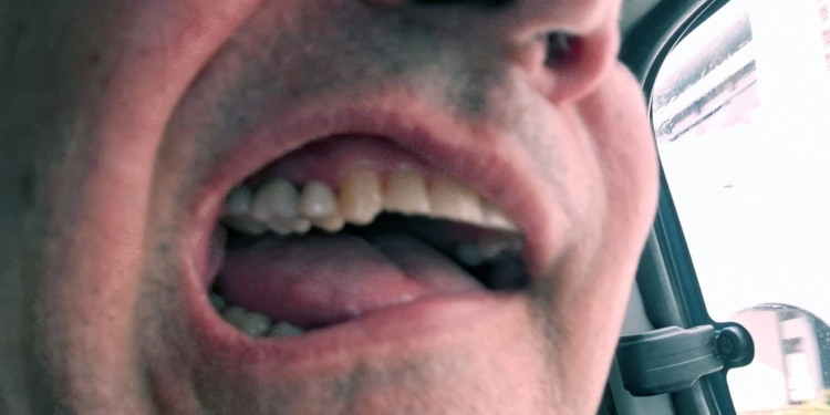 A close-up image of a person's open mouth, showing teeth and part of the tongue. The background includes a car window with a blurred view outside.